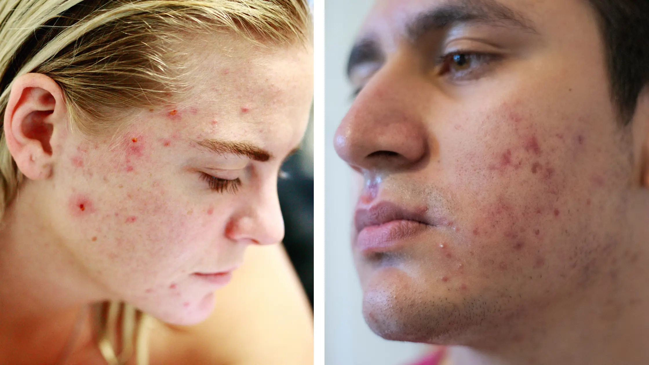 Acne Face Map for Men vs. Women acne map