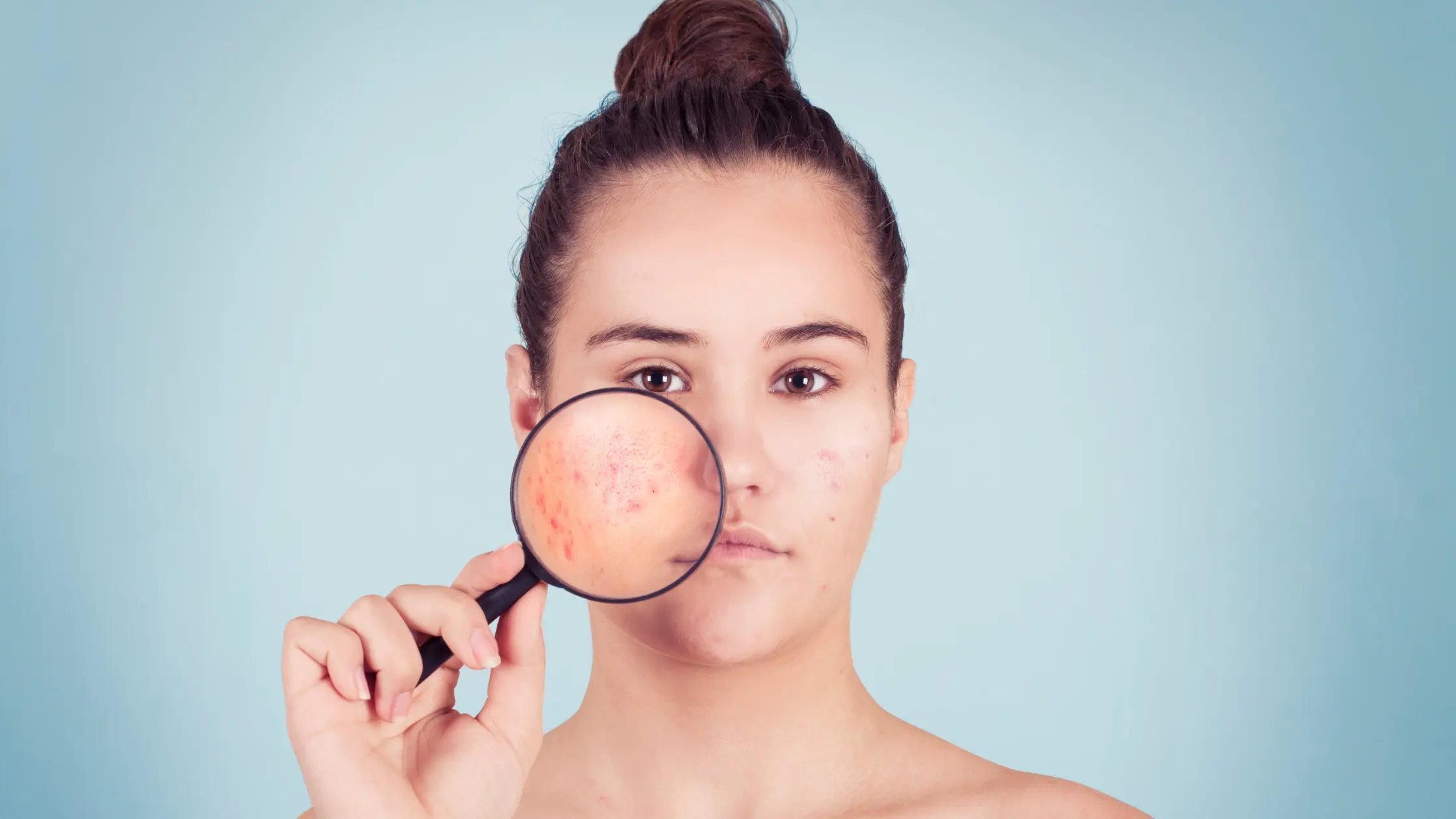 Myths About Acne Mapping acne pimple face map