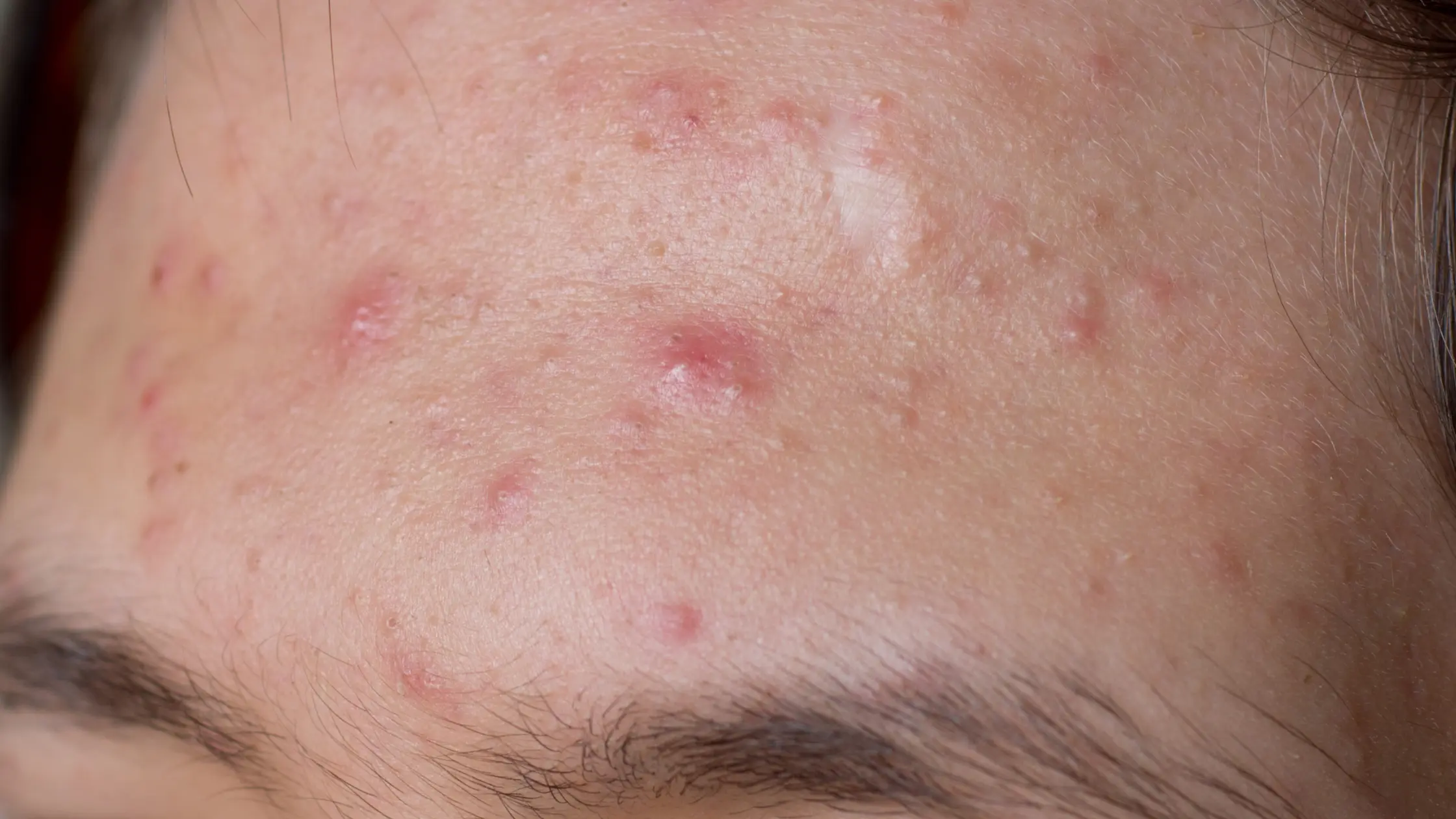 The Forehead Zone Stress and Digestion acne pimple face map