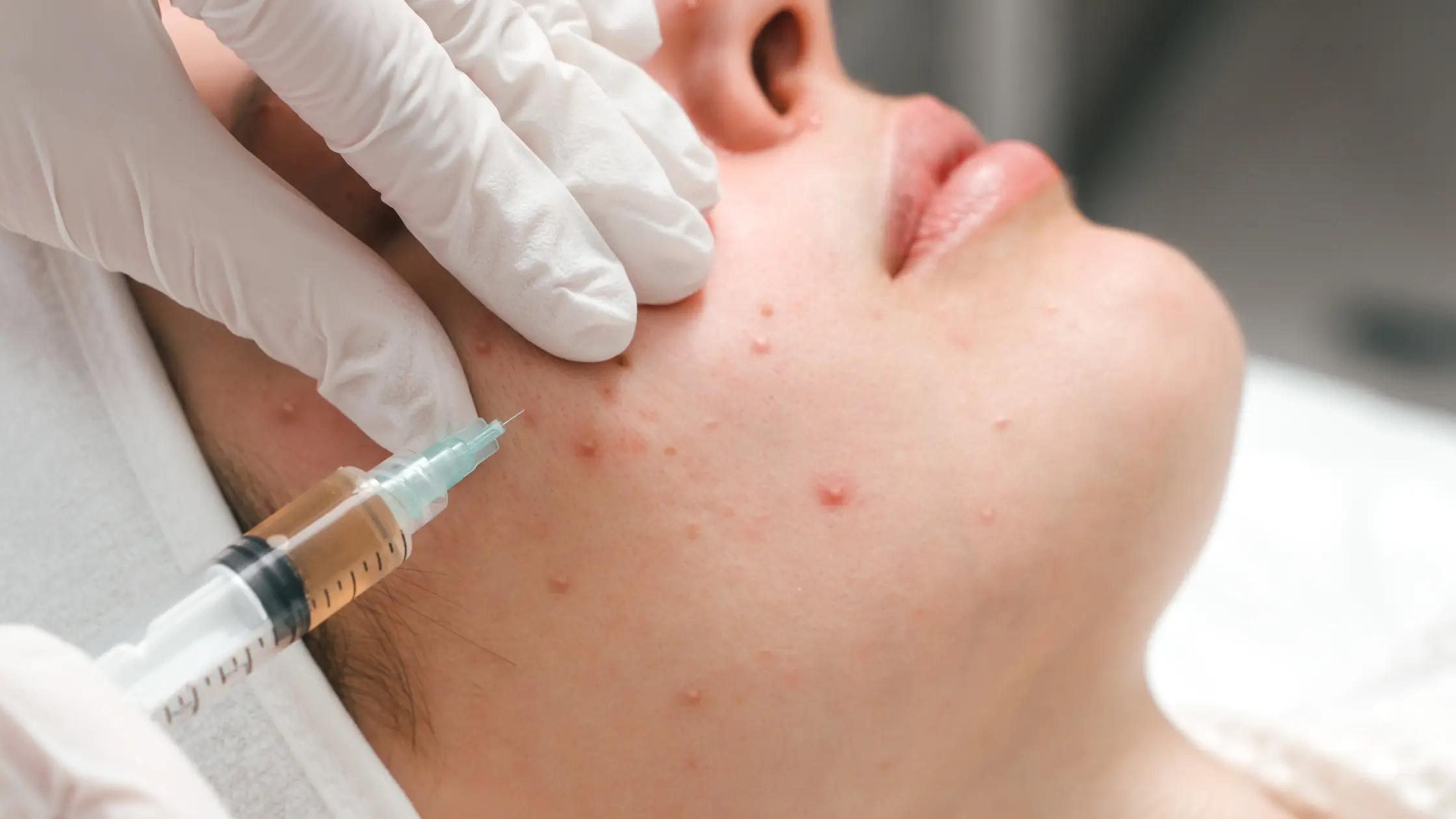 The History of Acne Face Mapping acne pimple face map