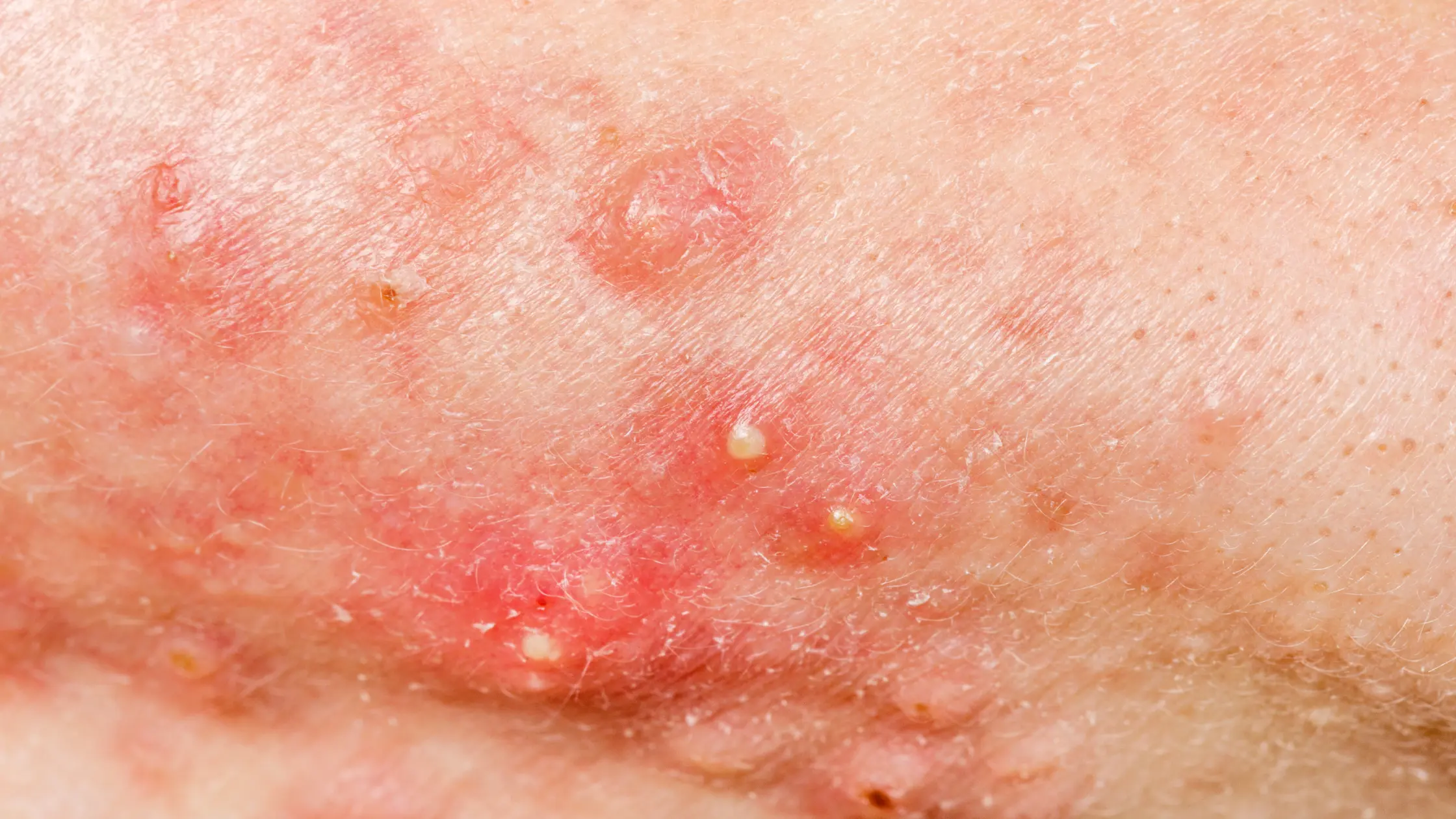 Why Understanding an Acne Map Matters acne pimple face map